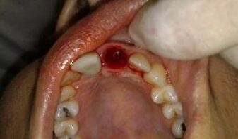the place of the extracted tooth